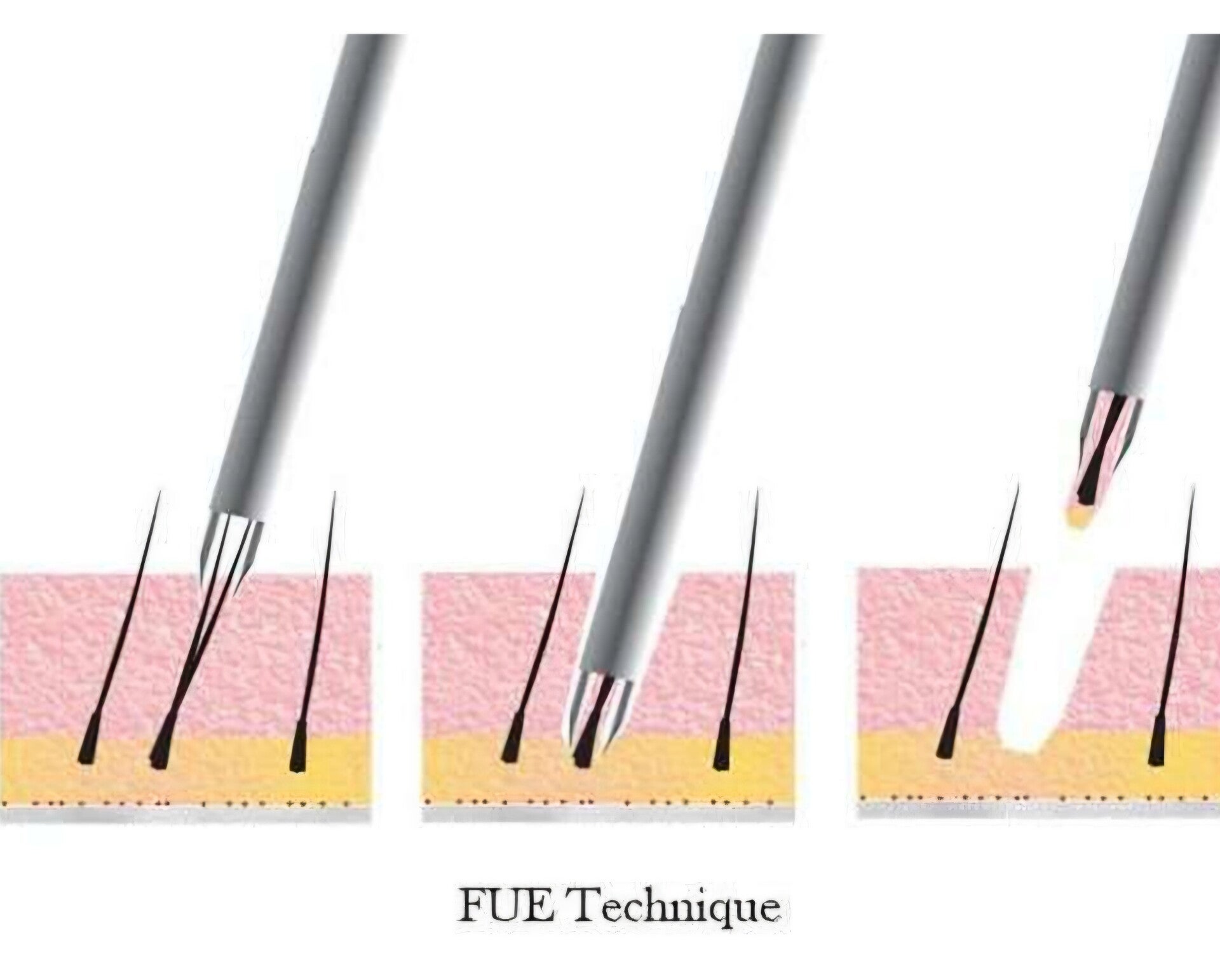 Illustration de l’extraction folliculaire FUE issue du site existant